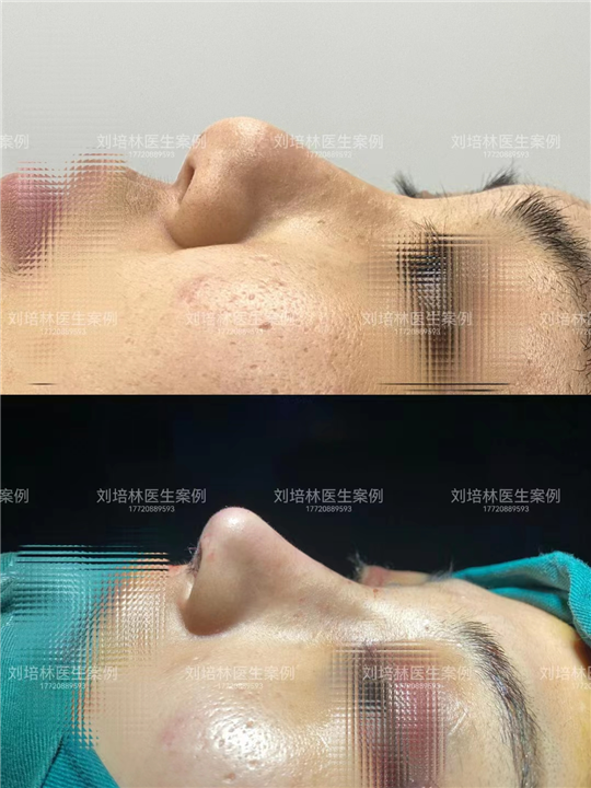 刘培林鼻综合整形