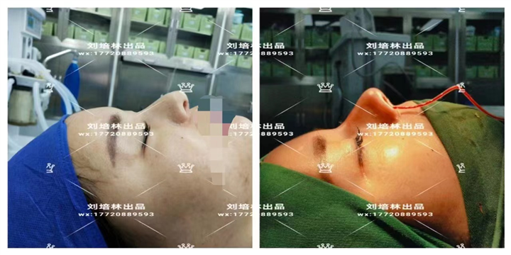 刘培林医生鼻整形修复案例