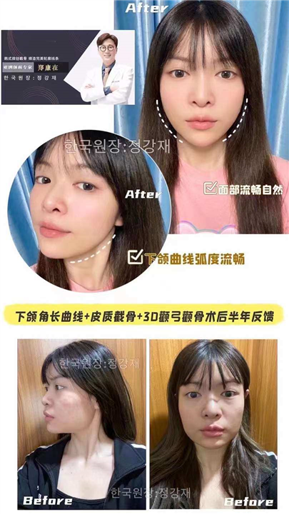 下颌角长曲线郑康在磨骨