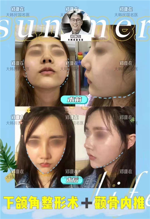 3D颧骨内推VLINE