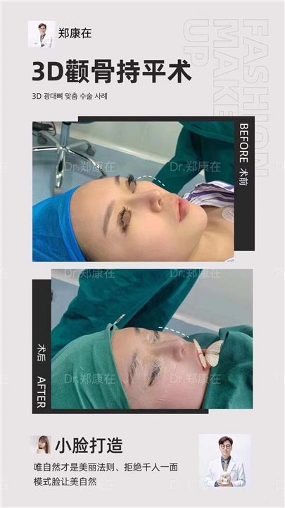 3D颧骨磨骨专家