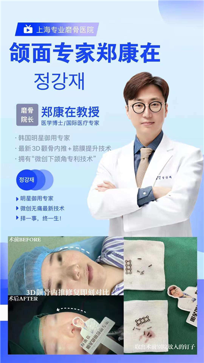3D颧骨磨骨多少钱