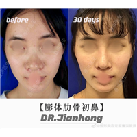 蹇洪整形医生妈生鼻案例分享