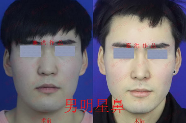 杭州鼻整形医生