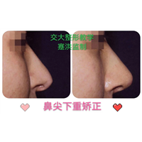 蹇洪医生鼻尖下垂矫正