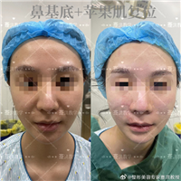 蹇洪教授苹果肌复位提升