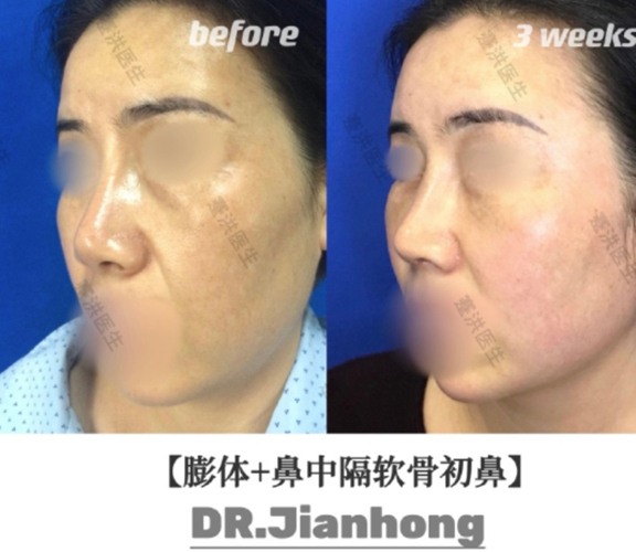 蹇洪教授鼻综合案例分享