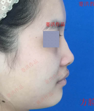 杭州面部轮廓整形