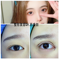 西安眼部整形医生推荐
