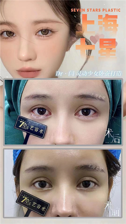上海闫娇君医生灵动少女卧蚕打造