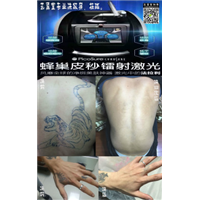 高邮哪里有洗纹身 