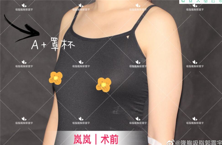 岚岚自体脂肪丰胸