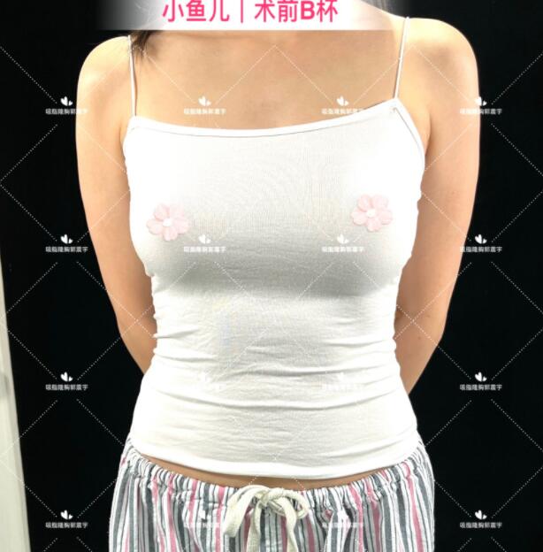 小鱼儿自体脂肪胸