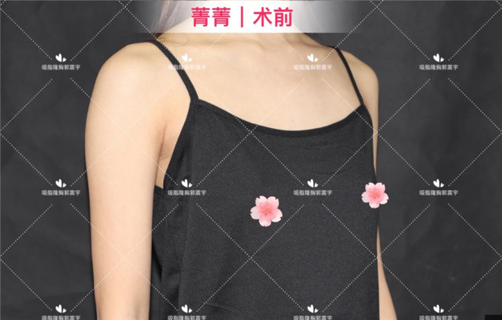 太平公主菁菁复合隆胸术后