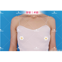 安安胸假体放胸大肌