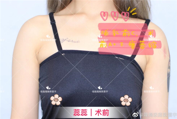 蕊蕊哺乳胸部干瘪丰胸后