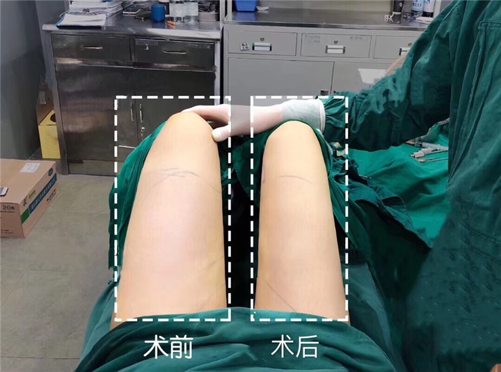 大腿吸脂
