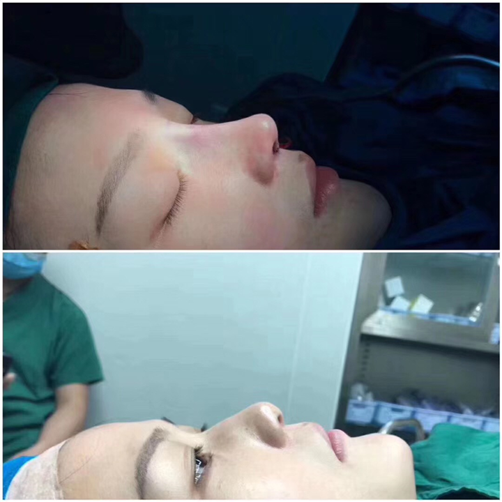 上海肋骨鼻综合整形