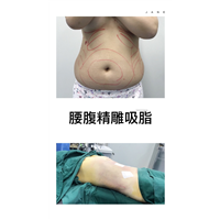 腰腹吸脂