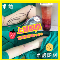 手臂吸脂