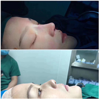 上海肋骨鼻综合整形