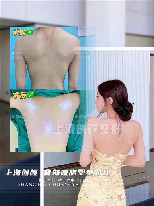 吸脂瘦身