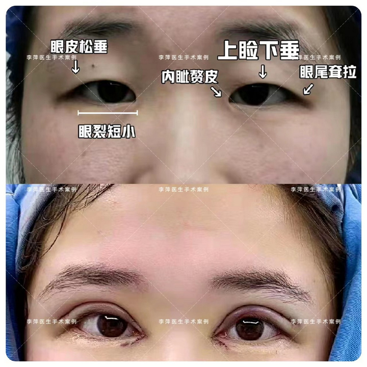 成都李萍整形医生