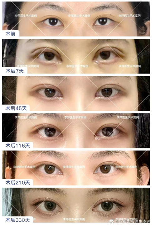 成都李萍整形医生