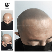整头纹发案例