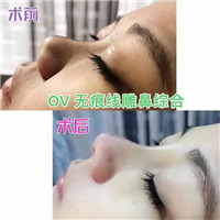湖南OV线雕脂肪移位|湖南线雕培训
