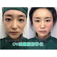 湖南微整形培训|湖南线雕培训