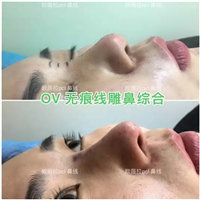 湖南OV线雕脂肪移位|湖南线雕培训