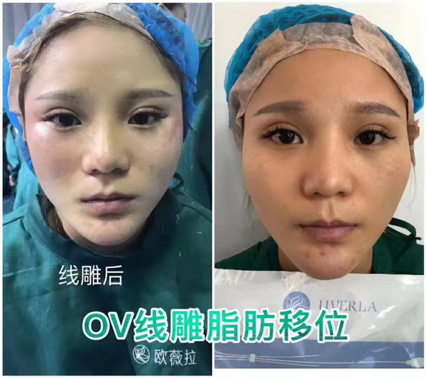 湖南微整形培训|湖南线雕培训哪家好