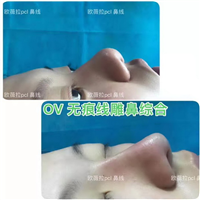 湖南OV线雕脂肪移位|湖南线雕培训