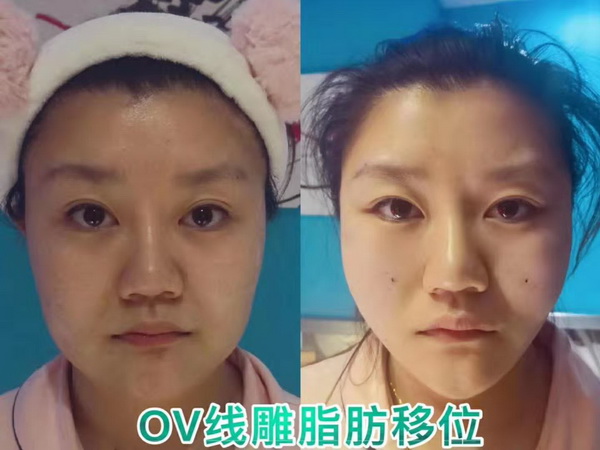 湖南微整形培训|湖南线雕培训哪家好
