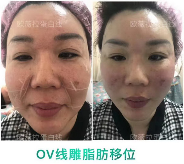 湖南微整形培训|湖南线雕培训哪家好