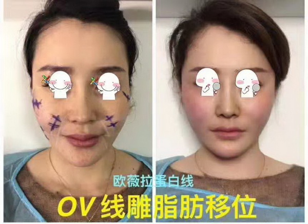 湖南微整形培训|湖南线雕培训哪家好
