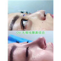 湖南OV线雕脂肪移位|湖南线雕培训