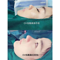 湖南OV线雕脂肪移位|湖南线雕培训