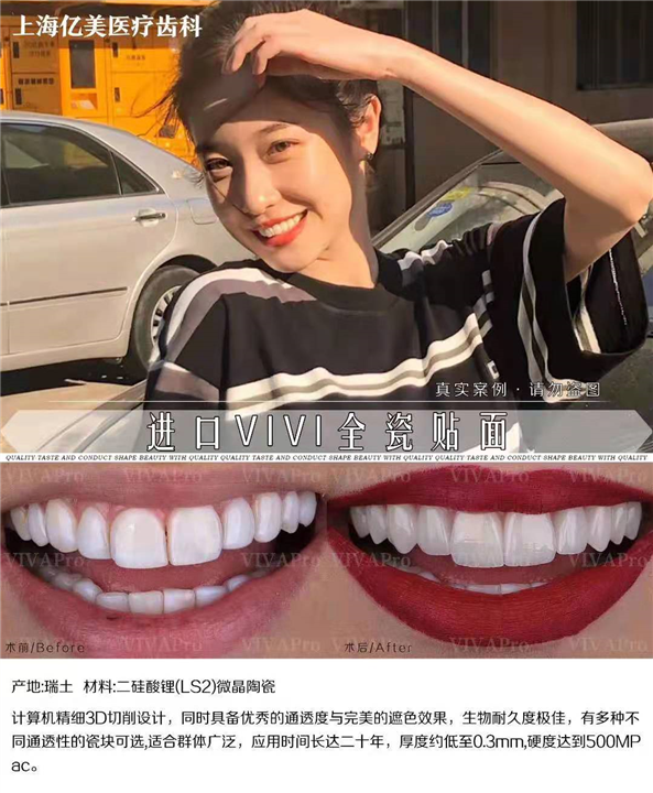 VIVApro专注牙齿美白 