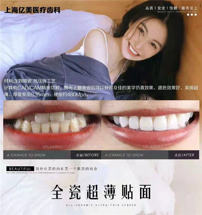 上海专业牙齿美白 