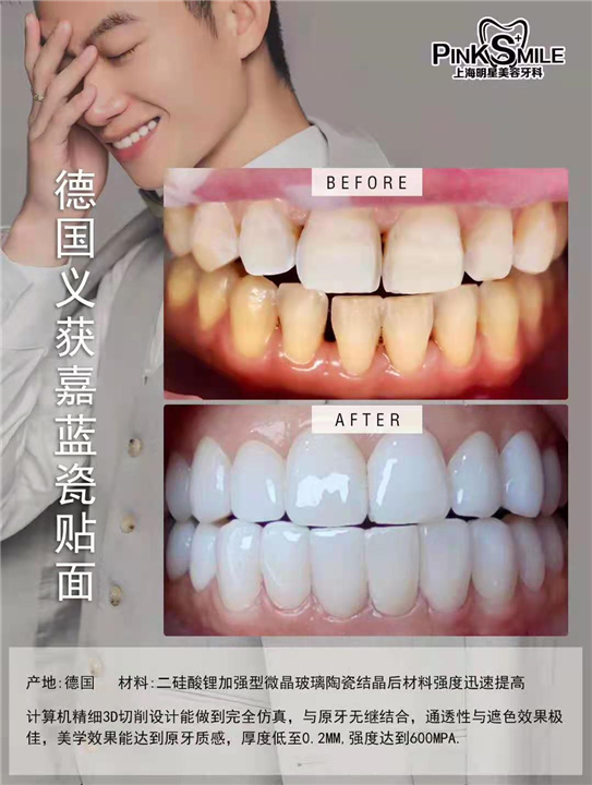 超薄E.MAX瓷贴面美牙 