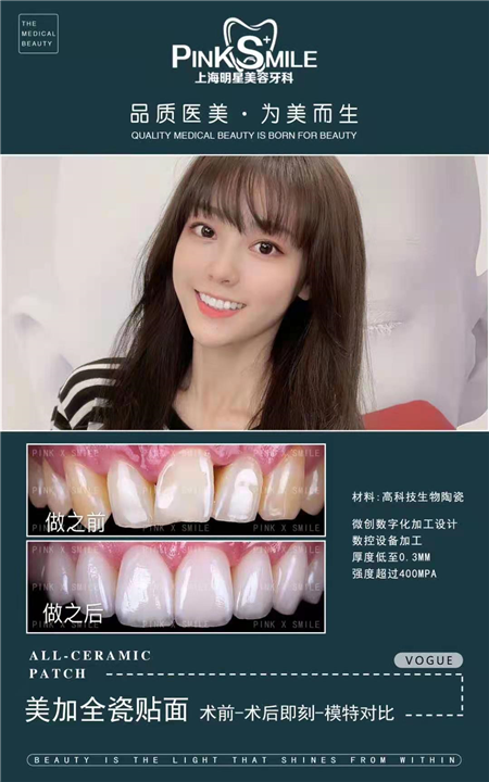上海有机瓷贴面美牙 