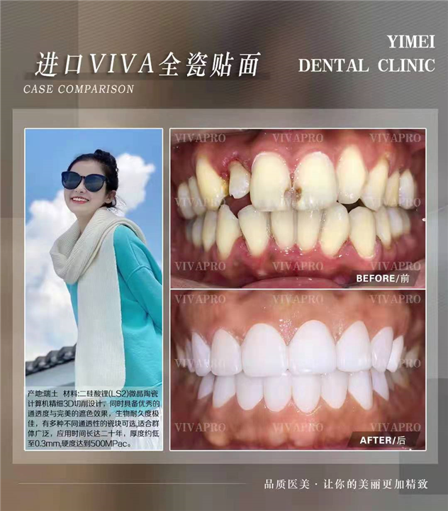 上海瓷贴面美白牙齿 