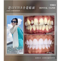 上海瓷贴面美白牙齿
