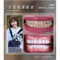上海牙齿美白多少钱