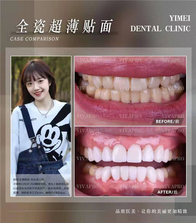 上海牙齿美白多少钱 