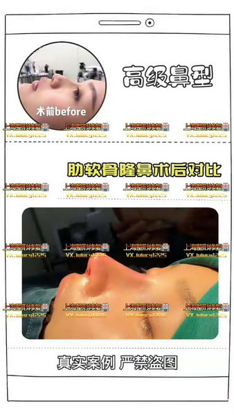 Facemaker修复整形