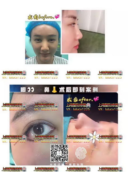 上海鼻综合整形|上海眼综合整形