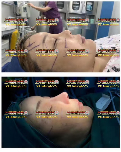 Facemaker修复整形
